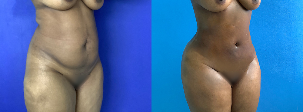 Liposuction before and after